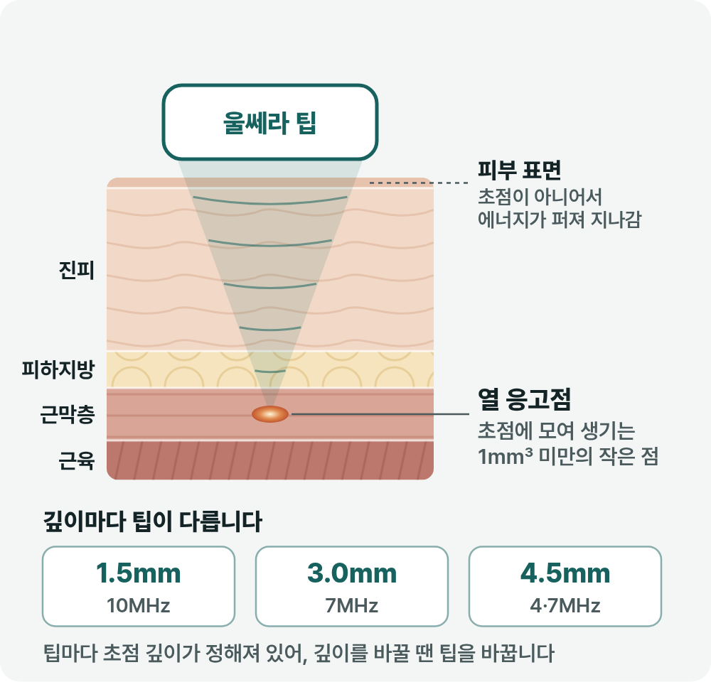 부산울써마지 초음파와 고주파, 피부 속 닿는 깊이가 다른 이유 사진 4