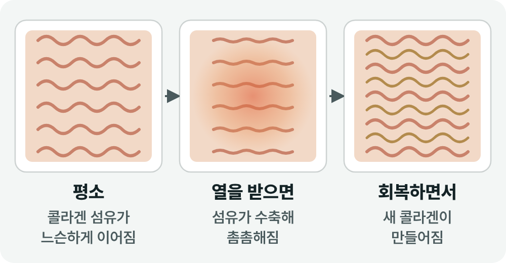 부산울써마지 초음파와 고주파, 피부 속 닿는 깊이가 다른 이유 사진 8