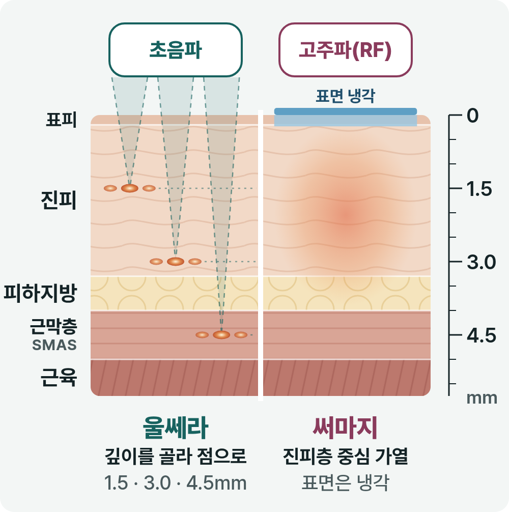 부산울써마지 초음파와 고주파, 피부 속 닿는 깊이가 다른 이유 사진 3
